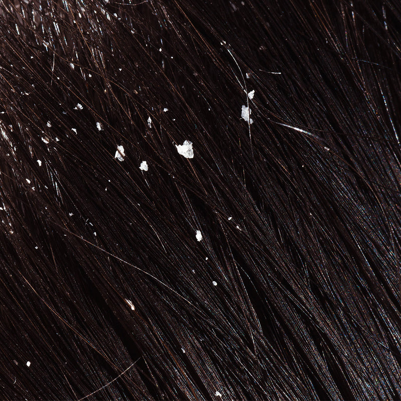 Unlocking the Secret to Dandruff-Free Hair